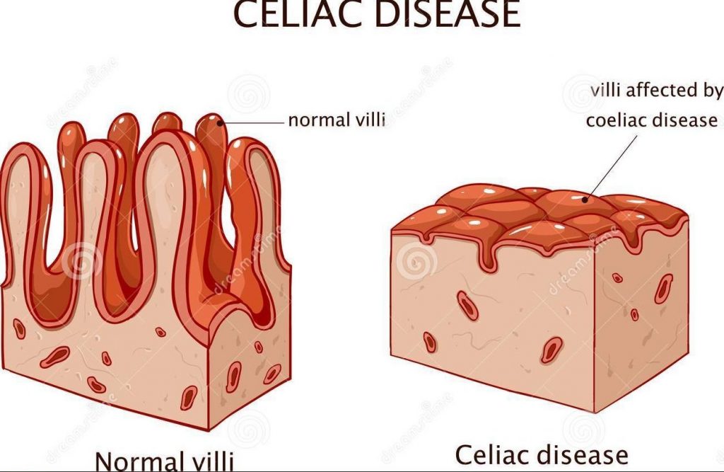 jejunal villi flattened in coeliac disease